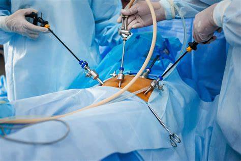 Laparoscopy